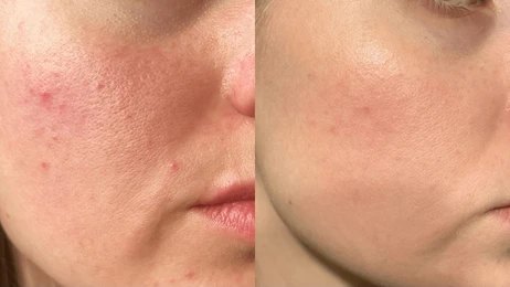 Acne Treatment
