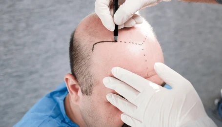 Direct Hair Implantation (DHI)