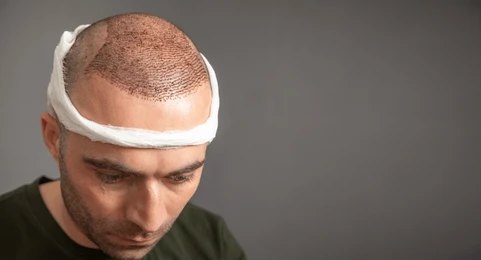 Follicular Unit Extraction (FUE)