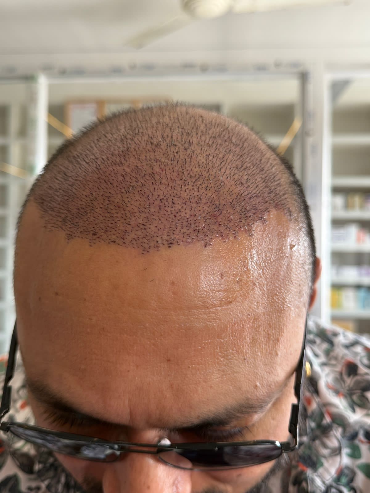 Hair Transplant Results After 7 Days