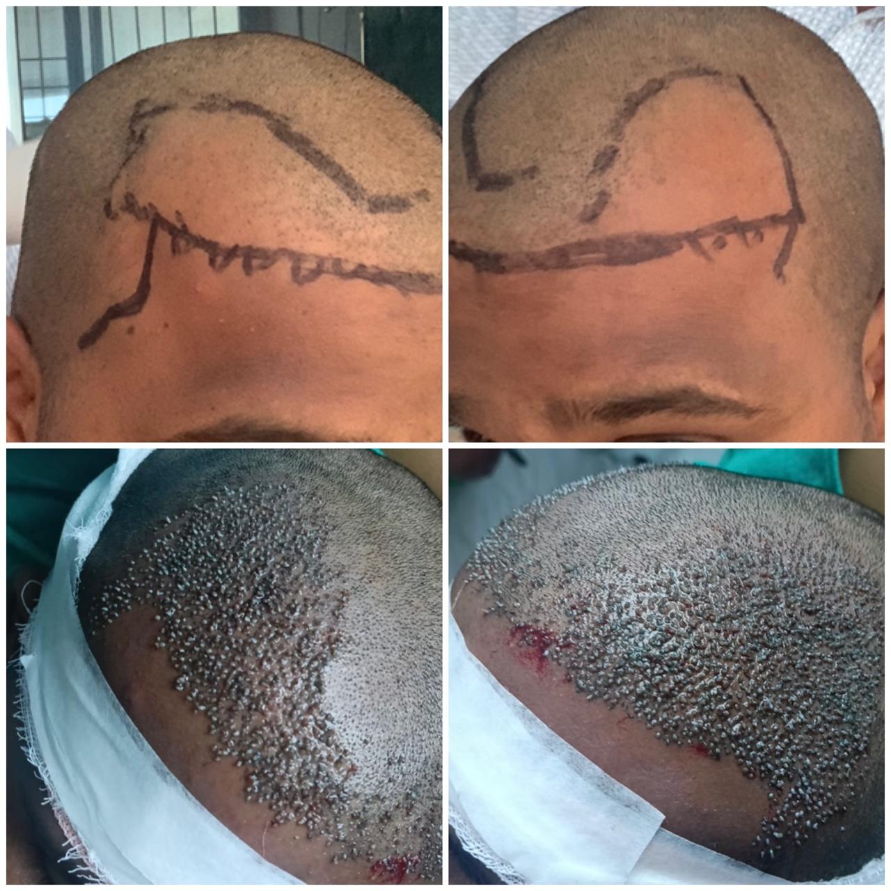 Hair Transplant Planning and Extraction Process