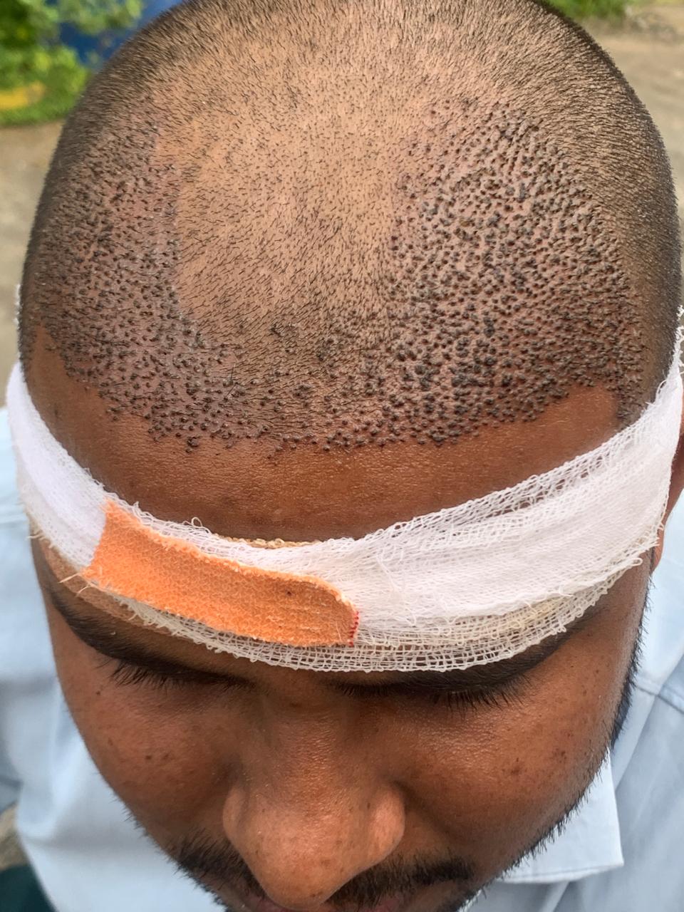 During Hair Transplant Procedure
