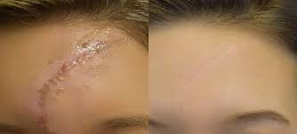 Scar & Dark Spot Removal