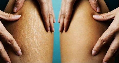 Stretch Mark & Wrinkle Treatment